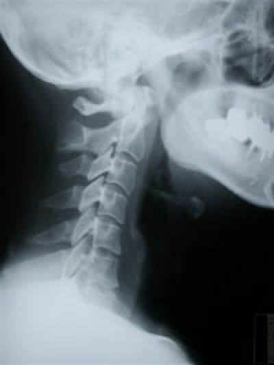 ムチウチ症状について